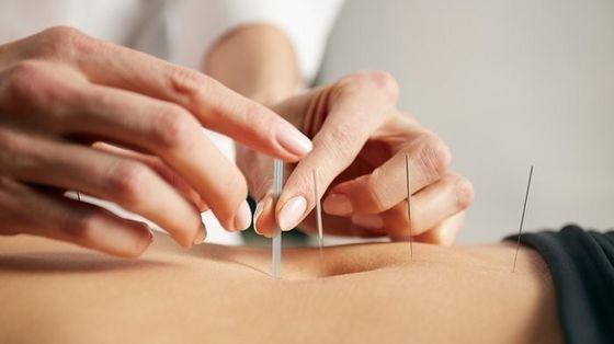 Cosmetische en medische intradermale acupunctuur naalden Rechte structuur die veiligheid en effectiviteit in acupunctuur verzekert